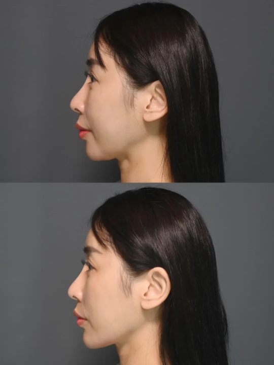 術後心得：立體度提升，素顏也順眼✨｜見證案例-Angel緁希